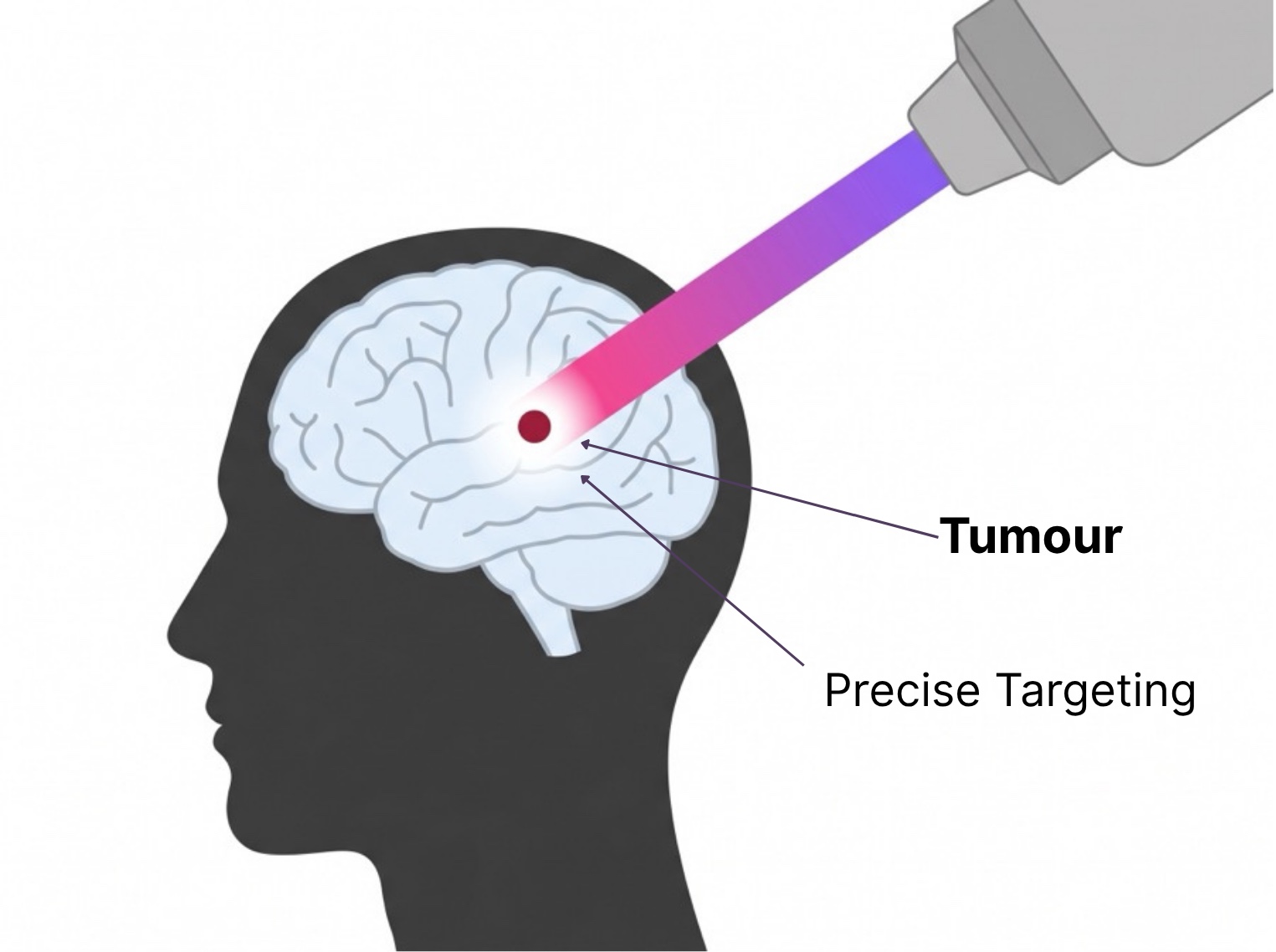 Diagram of proton beam therapy: the beam travels to the tumour and releases its energy at a single point, with no dose beyond it