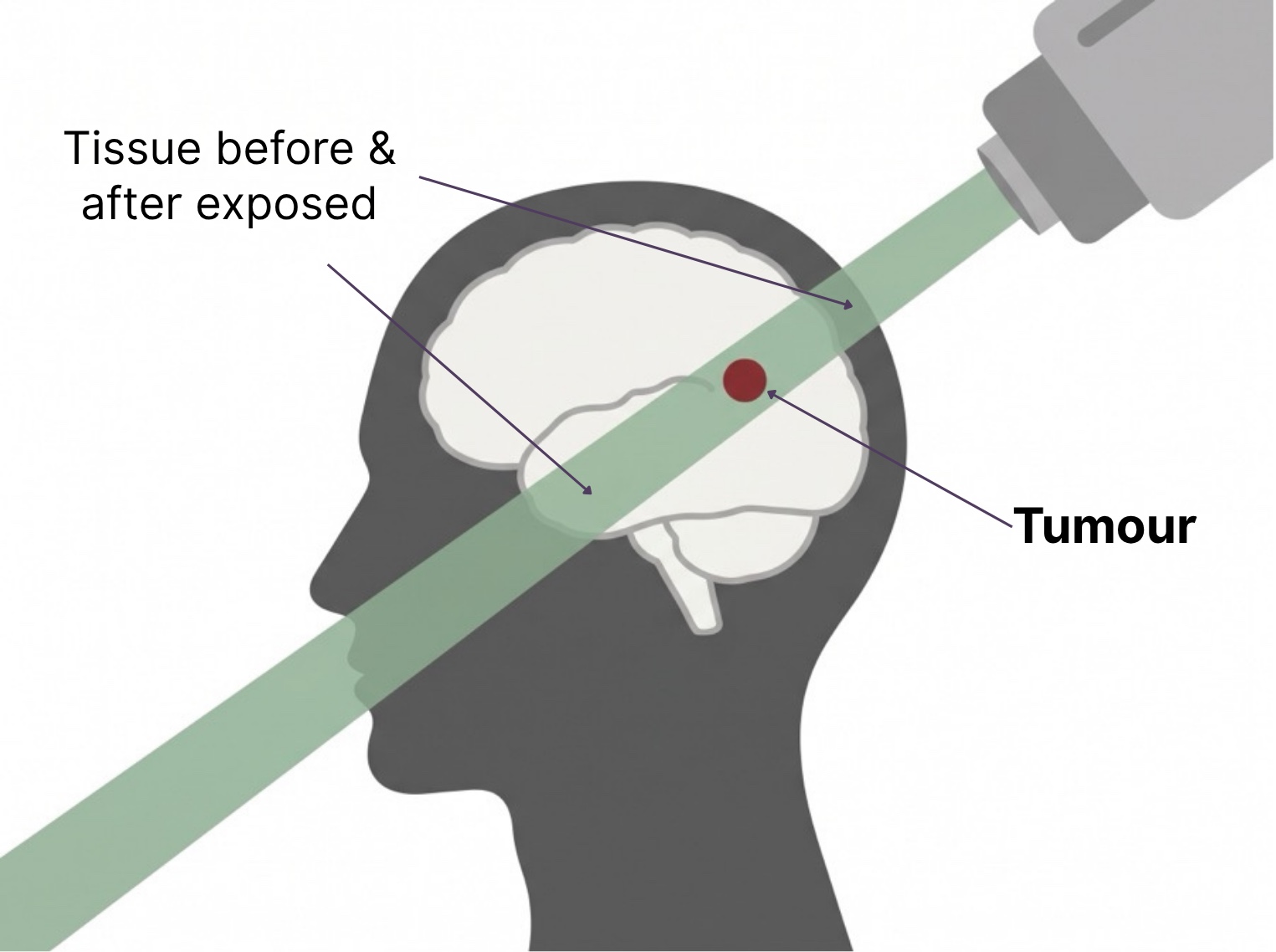 Diagram of standard X-ray radiotherapy: the beam passes through the entire head and exits the far side, depositing radiation along its whole path
